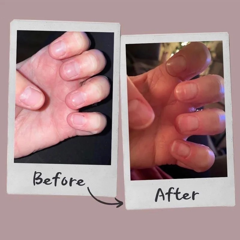 Brittle breaking nails showing strengthening treatment results before and after comparison