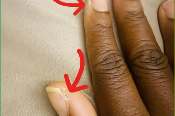 Close up of brittle weak peeling nails showing common damage from dehydration and nutrient deficiency causing nail splitting