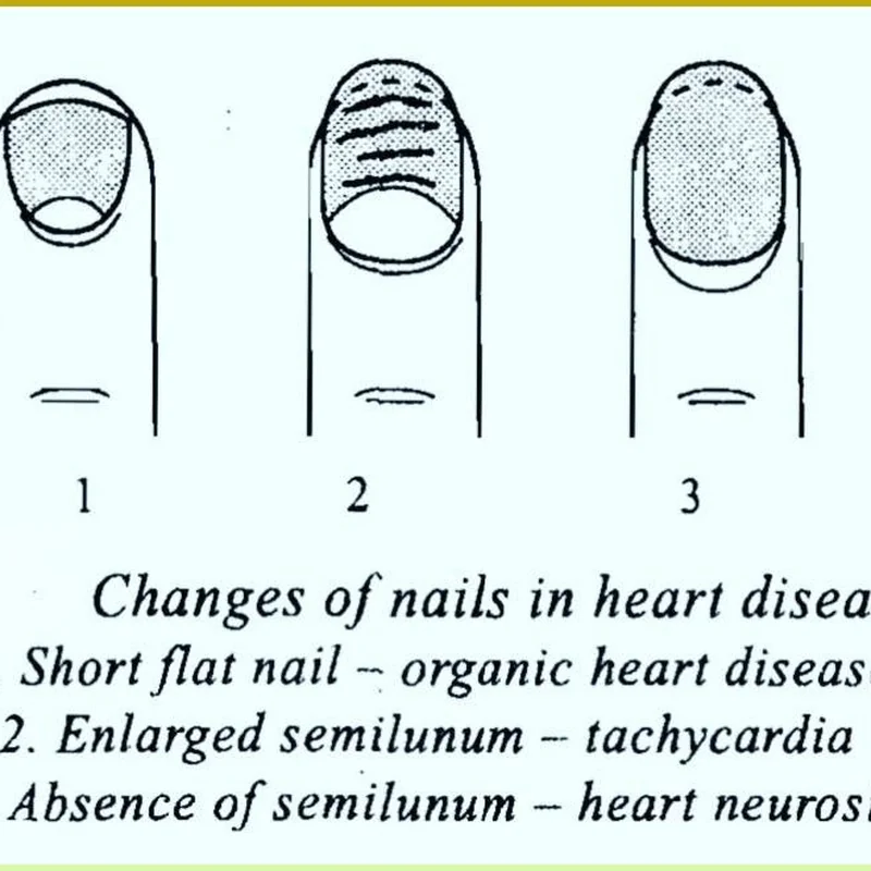 Horizontal Beau lines on nails indicating health issues and temporary growth disruption