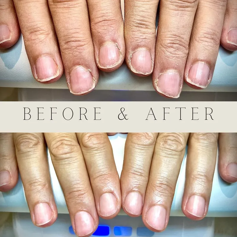 Peeling splitting nails showing before and after results from proper treatment and care routine
