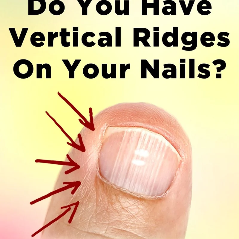 Vertical nail ridges close up showing causes and solutions with buffing treatment methods